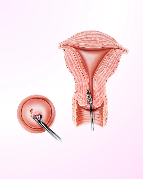 Cervical Dysplasia & Colposcopy Treatment in Jubilee Hills